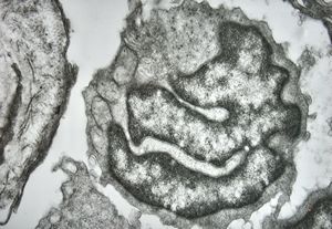 M, 70y. | mycosis fungoides - Sézary cell